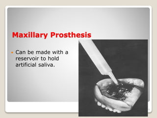 Maxillary Prosthesis 
 Can be made with a 
reservoir to hold 
artificial saliva. 
44 
 