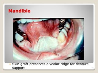Mandible 
 Skin graft preserves alveolar ridge for denture 
support 47 
 