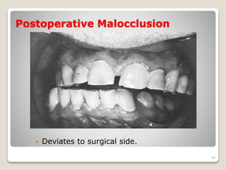 Postoperative Malocclusion 
 Deviates to surgical side. 
48 
 