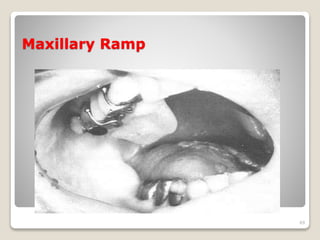 Maxillary Ramp 
49 
 