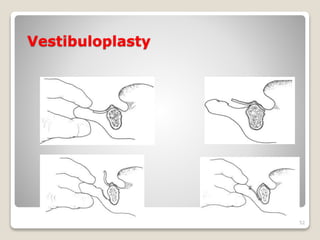 Vestibuloplasty 
52 
 