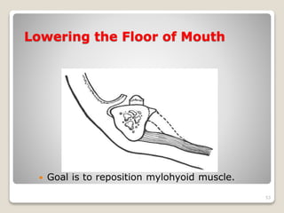 Lowering the Floor of Mouth 
 Goal is to reposition mylohyoid muscle. 
53 
 
