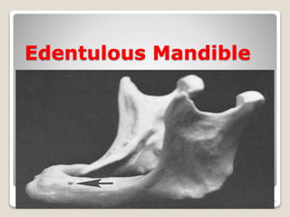 Edentulous Mandible 
55 
 