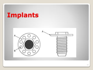 Implants 
57 
 