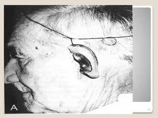 Extraoral 
Prostheses -- 
Ear 
60 
 