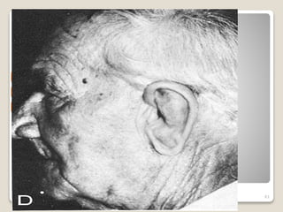 Extraoral 
Prostheses -- 
Ear 
61 
 