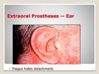 Extraoral Prostheses -- Ear 
 Tragus hides attachment. 62 
 