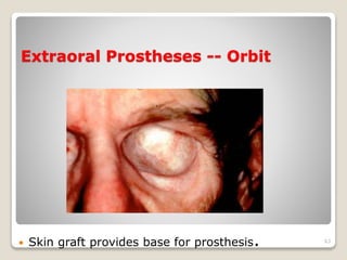 Extraoral Prostheses -- Orbit 
 Skin graft provides base for prosthesis. 63 
 
