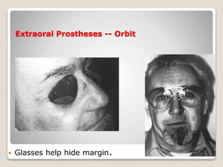 Extraoral Prostheses -- Orbit 
 Glasses help hide margin. 64 
 