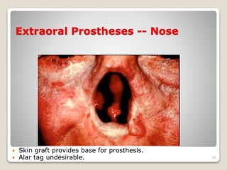 Extraoral Prostheses -- Nose 
 Skin graft provides base for prosthesis. 
 Alar tag undesirable. 65 
 