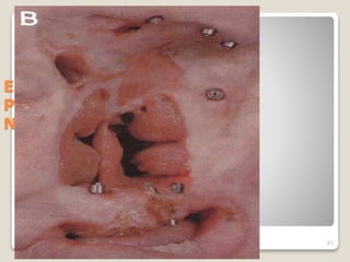 Extraoral 
Prostheses -- 
Nose 
67 
 