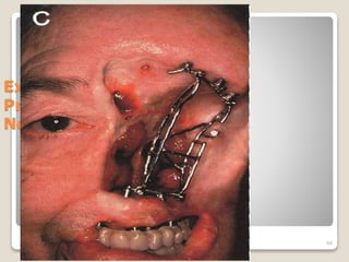 Extraoral 
Prostheses -- 
Nose 
68 
 