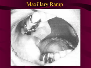 Maxillary Ramps Maxillofacial prosthodontics | PPT