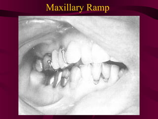 Maxillary Ramps Maxillofacial prosthodontics | PPT