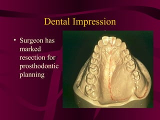 Dental Impression
• Surgeon has
  marked
  resection for
  prosthodontic
  planning
 