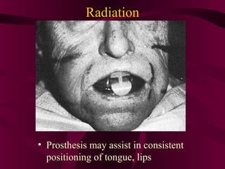 Radiation




• Prosthesis may assist in consistent
  positioning of tongue, lips
 