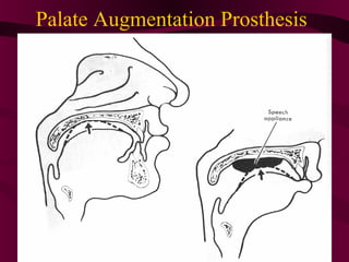 Palate Augmentation Prosthesis
 