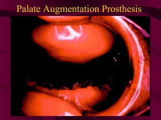 Palate Augmentation Prosthesis
 