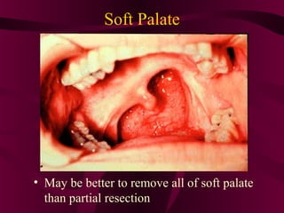Soft Palate




• May be better to remove all of soft palate
  than partial resection
 