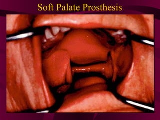 Soft Palate Prosthesis
 