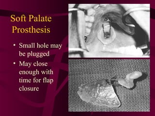 Soft Palate
Prosthesis
• Small hole may
  be plugged
• May close
  enough with
  time for flap
  closure
 