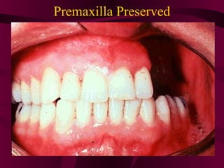 Premaxilla Preserved
 