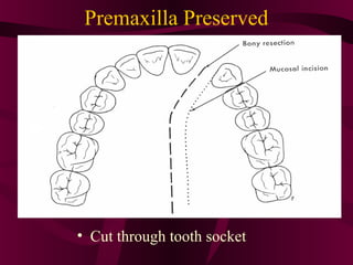 Premaxilla Preserved




• Cut through tooth socket
 
