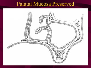 Palatal Mucosa Preserved
 