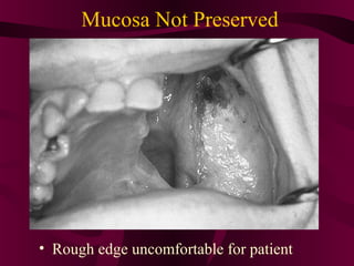 Mucosa Not Preserved




• Rough edge uncomfortable for patient
 