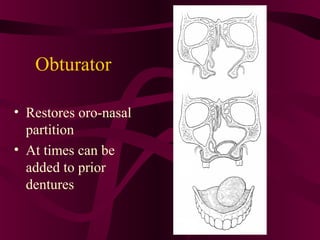 Obturator

• Restores oro-nasal
  partition
• At times can be
  added to prior
  dentures
 
