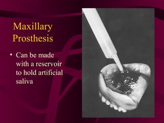 Maxillary
Prosthesis
• Can be made
  with a reservoir
  to hold artificial
  saliva
 