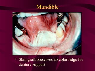 Mandible




• Skin graft preserves alveolar ridge for
  denture support
 