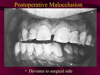 Postoperative Malocclusion




    • Deviates to surgical side
 