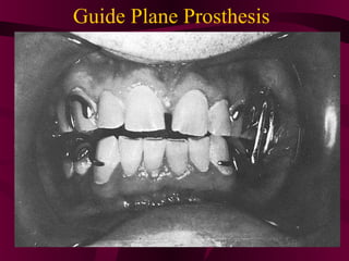 Guide Plane Prosthesis
 