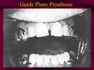 Guide Plane Prosthesis
 