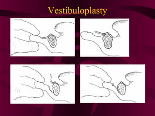 Vestibuloplasty
 