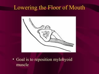 Lowering the Floor of Mouth




• Goal is to reposition mylohyoid
  muscle
 