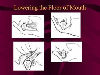 Lowering the Floor of Mouth
 