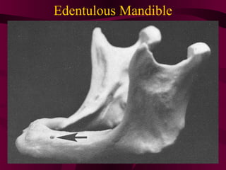 Edentulous Mandible
 