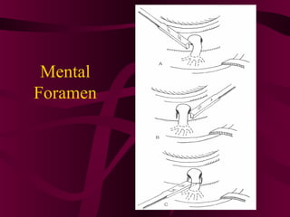 Mental
Foramen
 