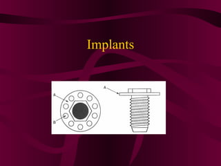 Implants
 