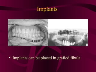 Implants




• Implants can be placed in grafted fibula
 