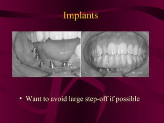 Implants




• Want to avoid large step-off if possible
 