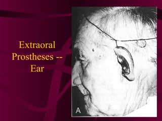 Extraoral
Prostheses --
    Ear
 