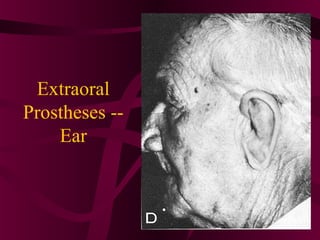 Extraoral
Prostheses --
    Ear
 