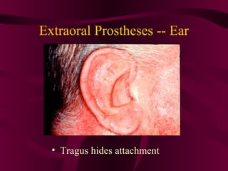 Extraoral Prostheses -- Ear




  • Tragus hides attachment
 