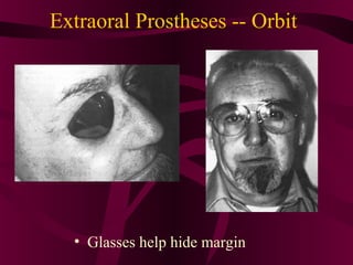 Extraoral Prostheses -- Orbit




  • Glasses help hide margin
 
