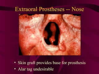 Extraoral Prostheses -- Nose




• Skin graft provides base for prosthesis
• Alar tag undesirable
 