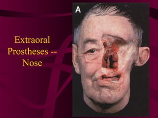Extraoral
Prostheses --
   Nose
 
