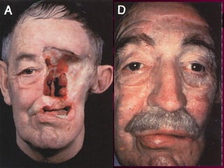 Extraoral
Prostheses --
   Nose
 